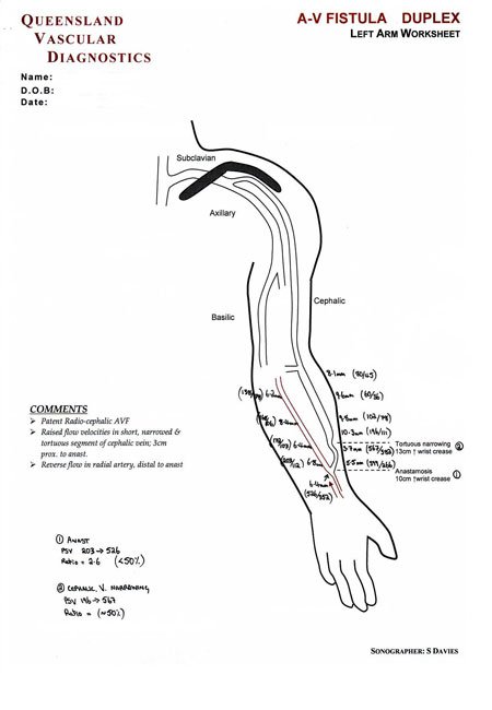 Upper Limb Arteries