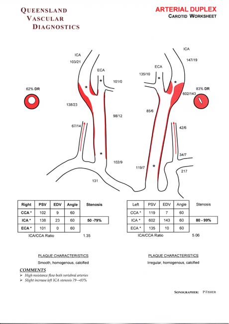 Carotid Duplex Scanning