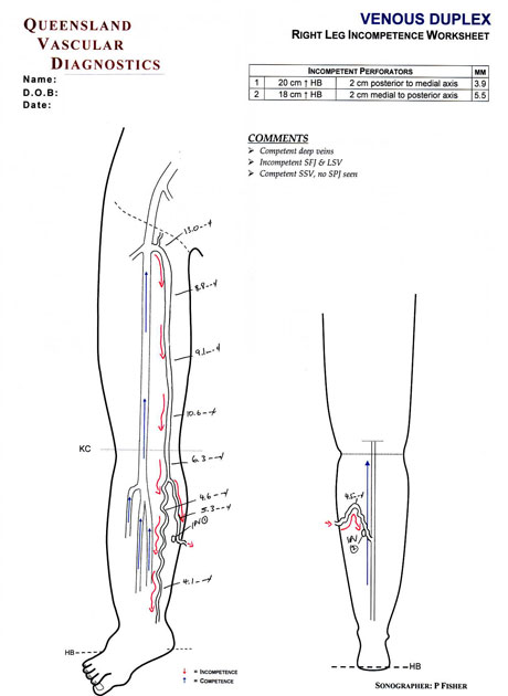 Varicose Veins   Venous Insufficiency